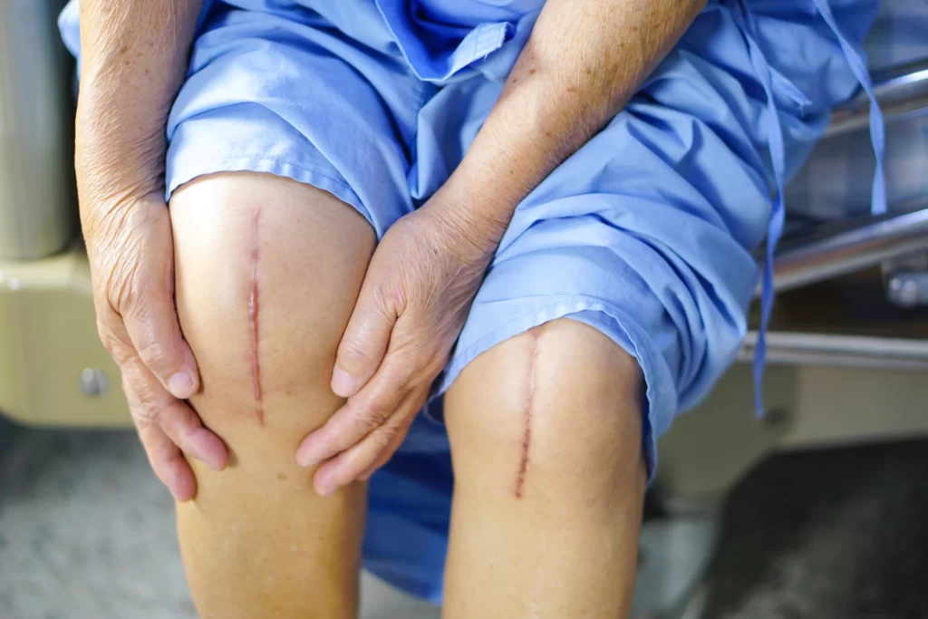 REQUIREMENT OF KNEE REPLACEMENT AND ITS OUTCOME