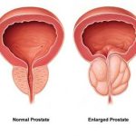 New Treatment Improves Enlarged Prostate Symptoms